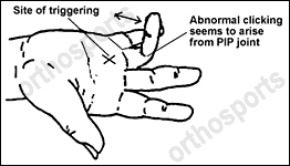 Trigger Fingers 